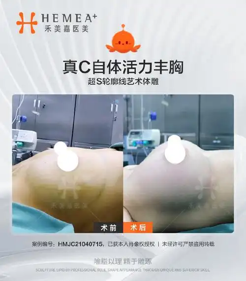 从a罩杯→c罩杯的飞升  真c自体活力丰胸术后即刻效果  手感真实柔软