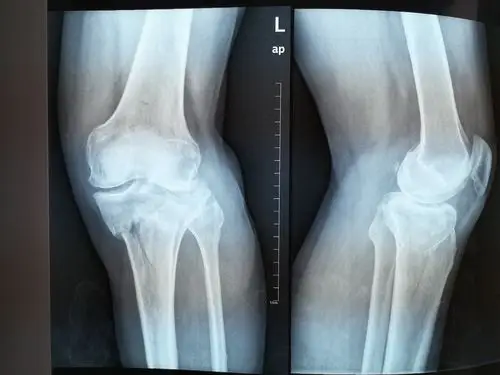 胫骨平台骨折的微创手术