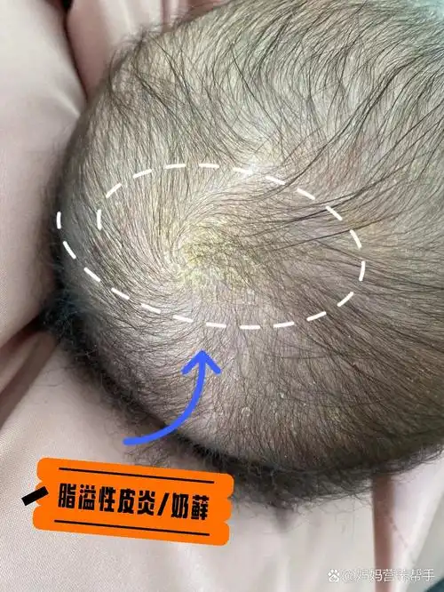 孜恩传|宝宝头顶9615"奶藓"?