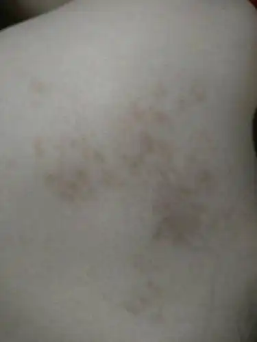 背部左肩部分出的斑,原来只有一小块,现在好多,谁知道这是什么斑?