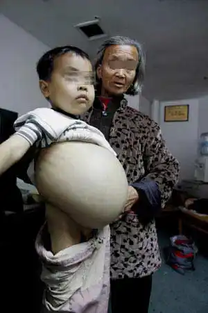 肚子大如临产孕妇,常年流鼻血,发高烧,靠定期换血来维持生命