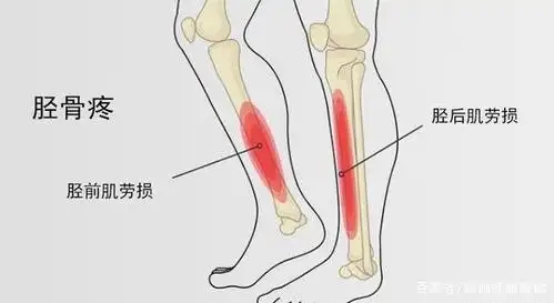 脚底筋膜炎除了可以进行上述的练习之外,放松缓解足弓也是很重要的.