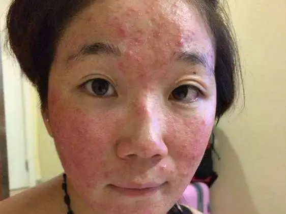 患者使用药物初期或者是一段时间后,药物会刺激皮肤产生一定的反应,是