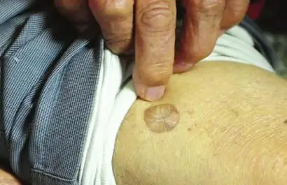 李圣言腿上被子弹击穿留下的伤疤.杨涛摄