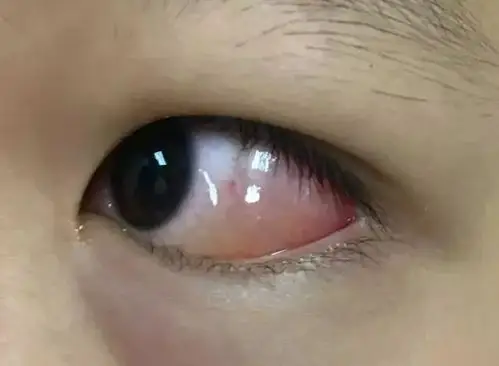 荔枝蝽尿液入眼睛后出现结膜水肿现场处理就近找干净水源(自来水,矿泉