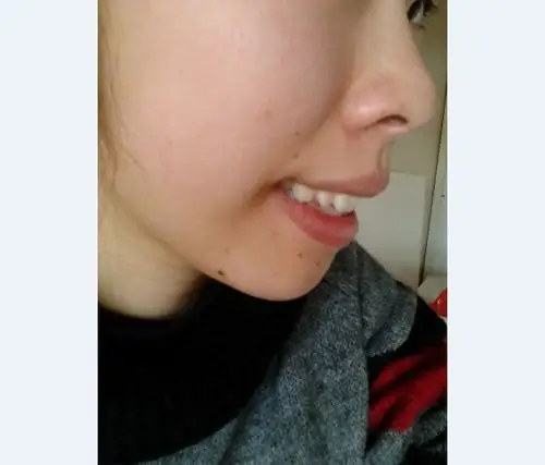 我今年二十岁了嘴巴前突应该是上排牙龈引起 拔牙后牙龈会跟着牙齿被