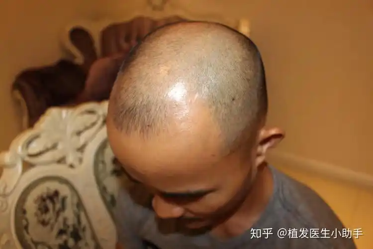 案例分型m型脂溢性脱发