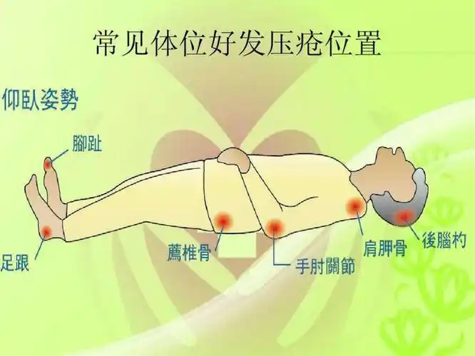 压疮的预防健康宣教