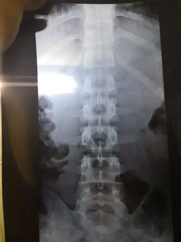 麻烦帮忙看一下x光,看看伤在哪里了,腰痛