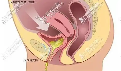 姐姐和我做过缩阴紧缩术两年的亲身经历,管几年看个人差异