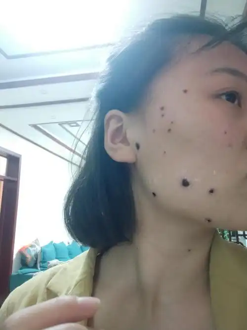 痣多星30多个 药水点痣后怎么不留疤呀