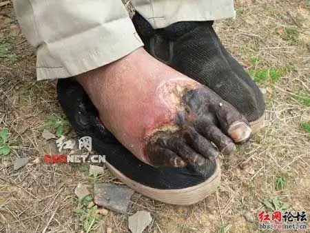 男子右脚腐烂长蛆医治难 网友发动爱心募捐(图)