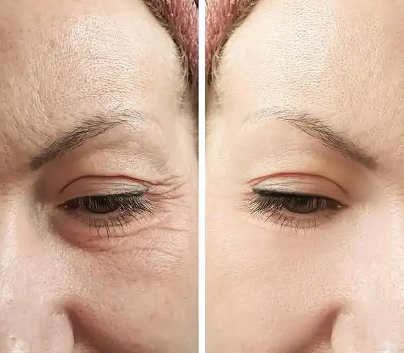 上眼皮松弛,眉上切口和眉下切口怎么选择?