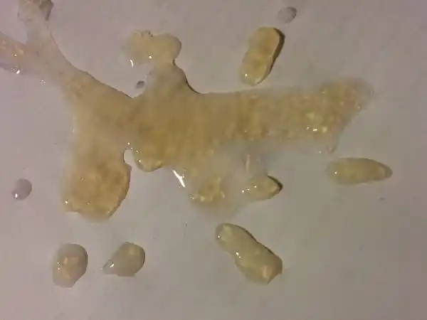 精液异常是怎么回事精液异常有哪几种表现