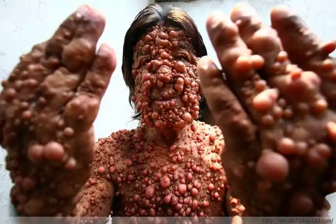 印尼男子全身疯长恐怖肿瘤 - 趣看天下的日志 - 网易博客