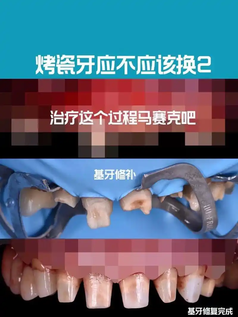 烤瓷牙换全瓷牙的真实原因码起来