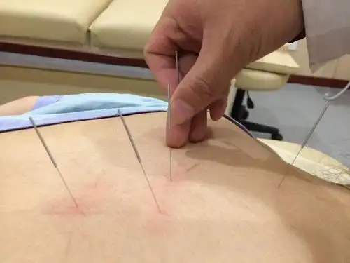 癫痫综合征中医治疗方法之针灸