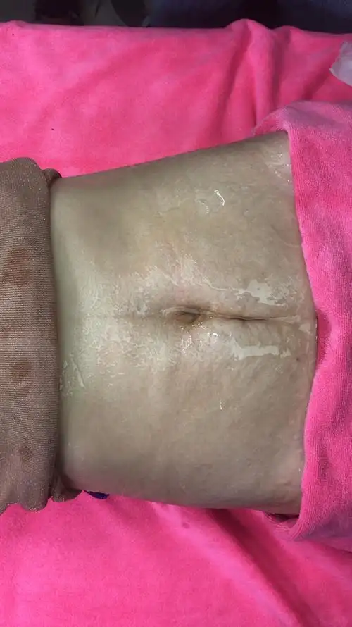 生完孩子肚子松弛,被老公嫌弃,和闺蜜一起排油减脂,她瘦了48我瘦了51