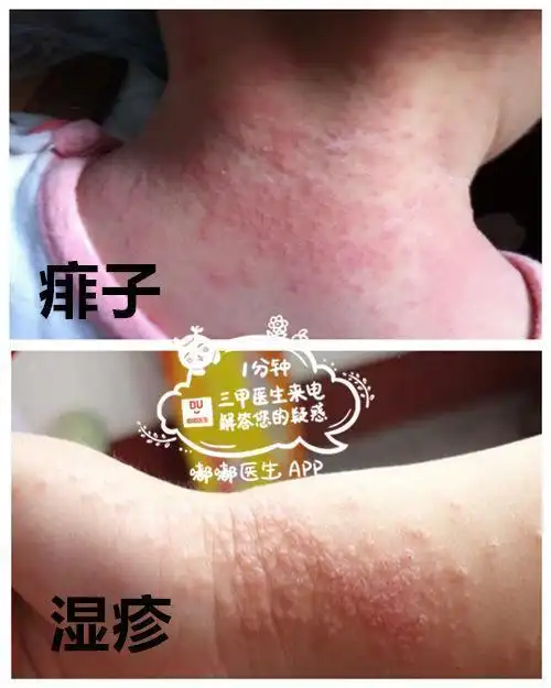 新生儿湿疹和痱子有何区别?该如何护理?