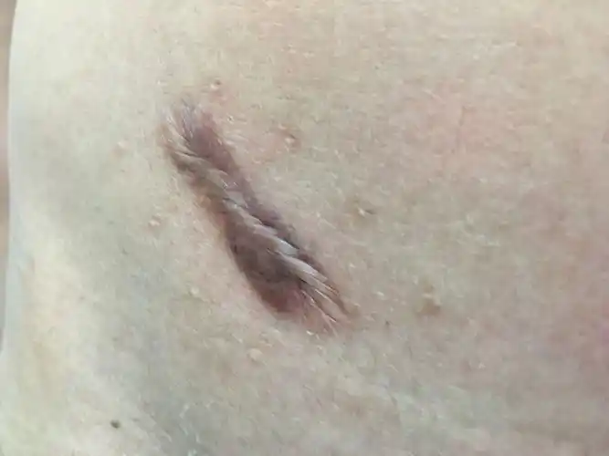 本人高二 两年前动的急性阑尾炎手术 手术过后留下的疤痕 现在疤痕长