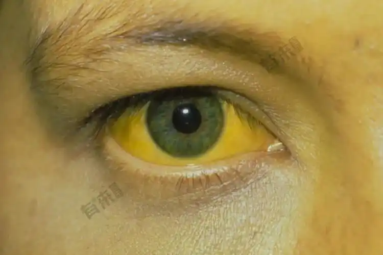 皮肤巩膜黄染图