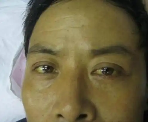 3,眼睛发黄,肝硬化黄疸