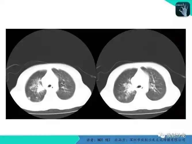 【每日一例 | 427期】原发性肺结核