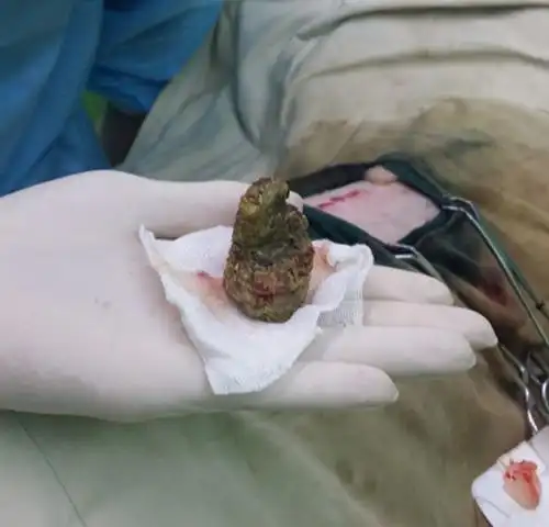 小儿肠梗阻后解除后解什么颜色大便