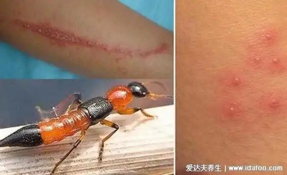 com四,蜱虫咬人后的伤口图人体被像虱子,跳蚤,蜱虫,蜜蜂,隐翅虫等虫豸