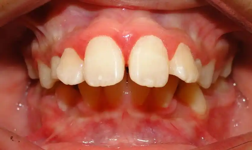 牙齿不齐等错(牙合)畸形的危害