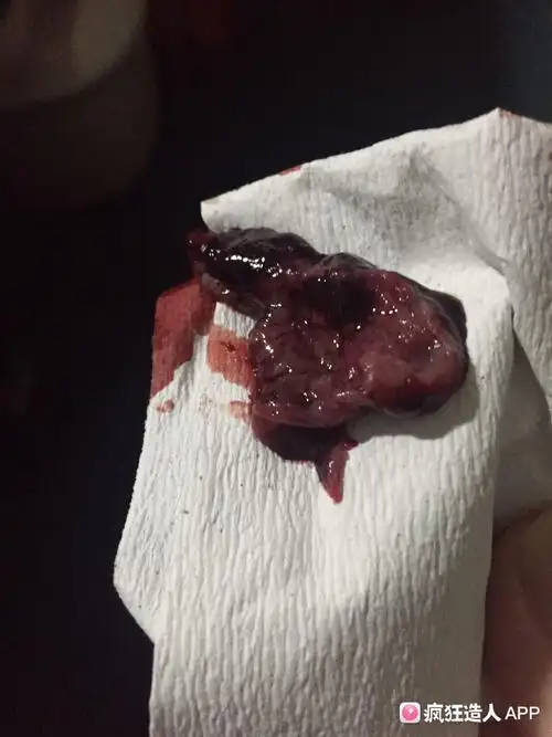 药流排出来的,这是孕囊吗?(有图慎入)