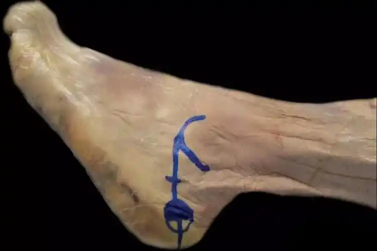 外固定跟骨位置从哪儿以何种角度穿针更安全