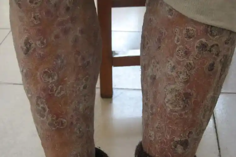 三期结节性梅毒疹