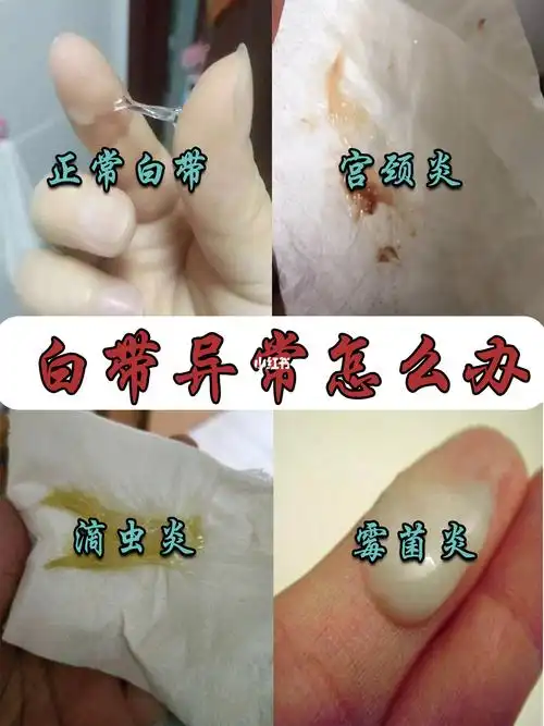 白带异常怎么办?
