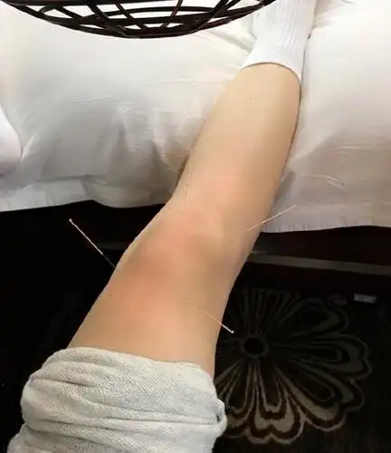 景甜拍打戏落下后遗症靠针灸理疗缓解图