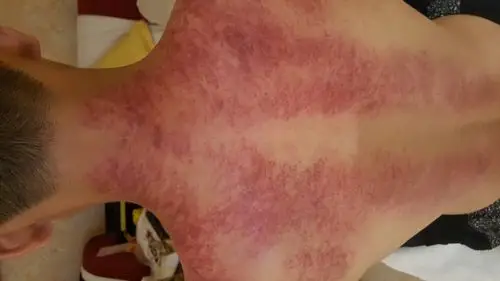 刮痧师傅说我这个发紫发黑很严重 要怎么办啊 是第一次刮 有点慌