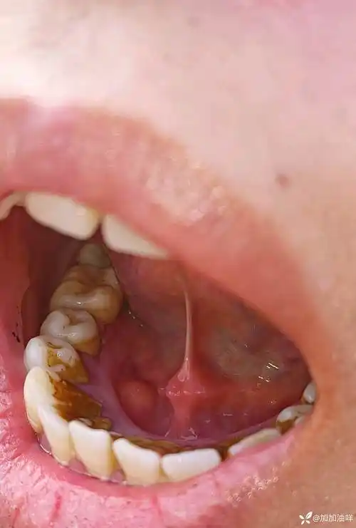 47岁女性口腔下颌右下34牙齿下面有肿物触硬感觉患者说像颗牙一样