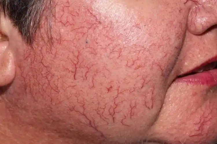 脸上有红血丝怎么办