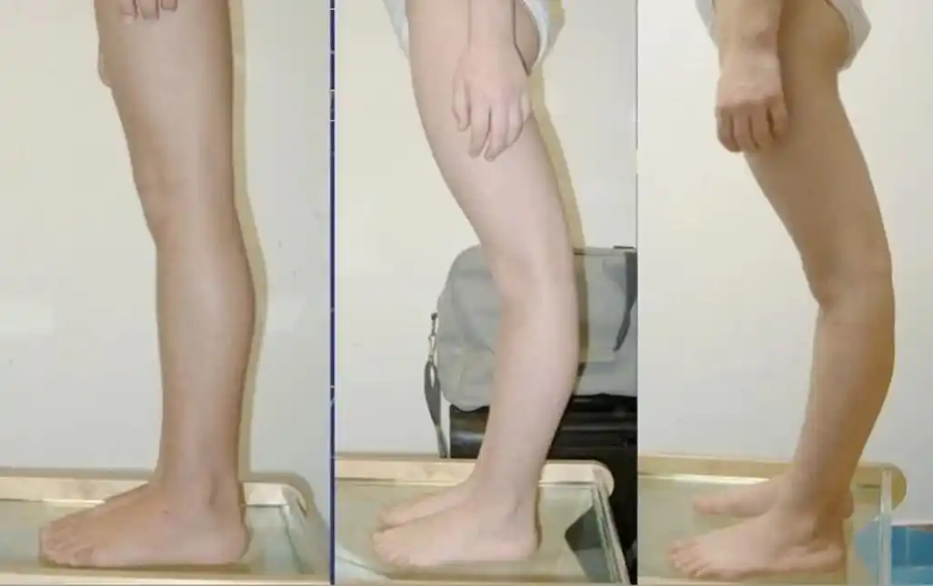 一,腿为啥伸不直?