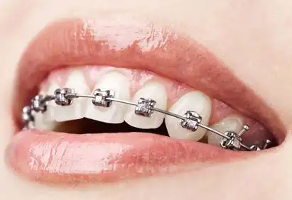 普通钢丝托槽矫正