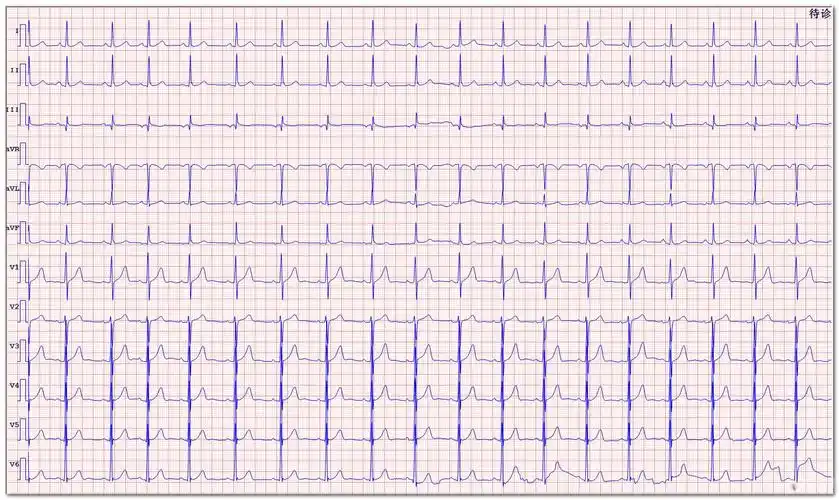 临床检查区 69 心电图脑电图专业讨论版 69 求助:这些异常p波是