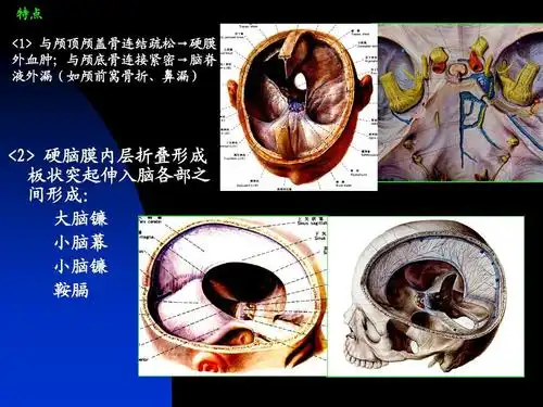 2> 硬脑膜内层折叠形成 板状突起伸入脑各部之 间形成: 大脑镰 小脑