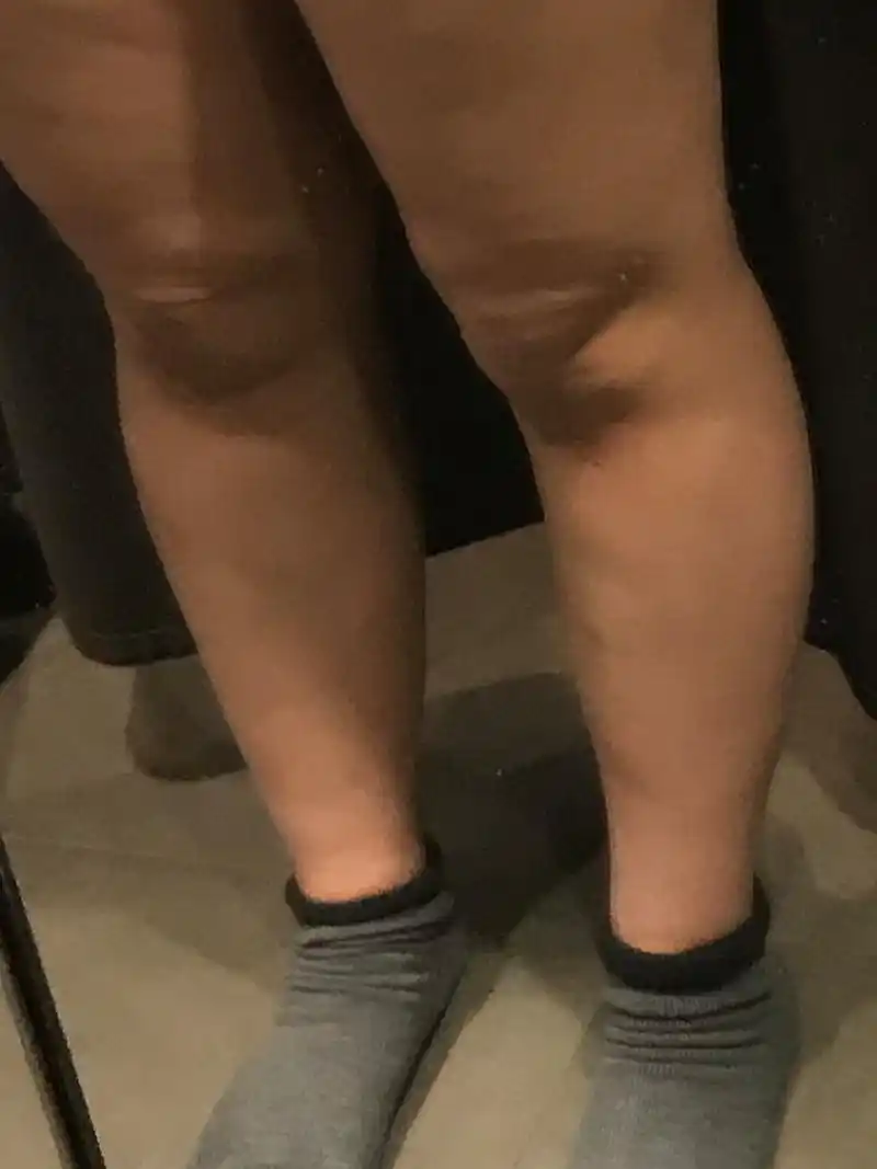 我的腿～大概是世界上最丑的05 小腿很短,而且小腿肌肉外翻,大腿