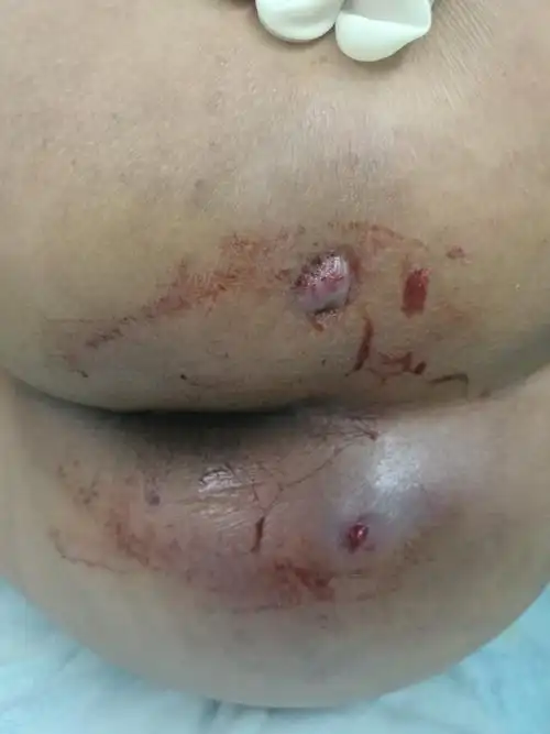 肛周脓肿怎么诊治2 - 好大夫在线