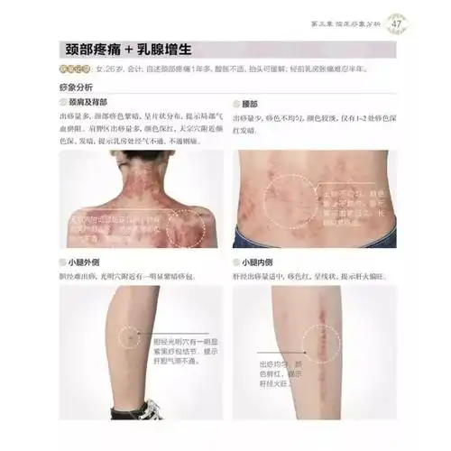 刮痧刮哪里祛痘(长痘刮痧刮哪里排毒) - 美白小窍门 - core美容日记网