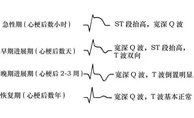 优鼎医护一张图教你看懂心电图护士必知