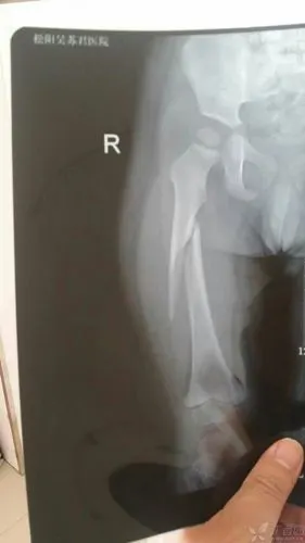 小儿股骨骨折1例