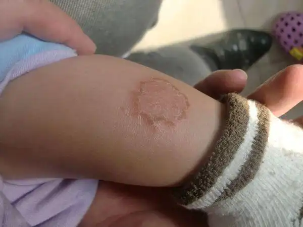 2种药1:1混合涂抹,现在还没用呢 如果你家有治湿疹的药,可以先抹点.