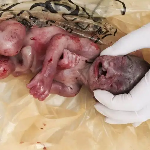 【一线报道】120b超室经四维彩超诊断胎儿唇腭裂一例