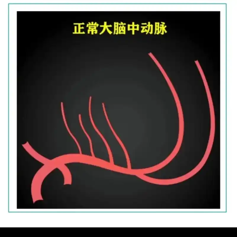 #医学科普 大脑中动脉 - 抖音
